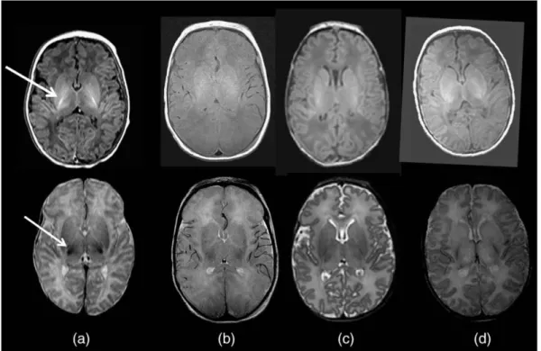 Figure 3. MRI images comparing the brain of a healthy term neonate with three  term neonates with HIE