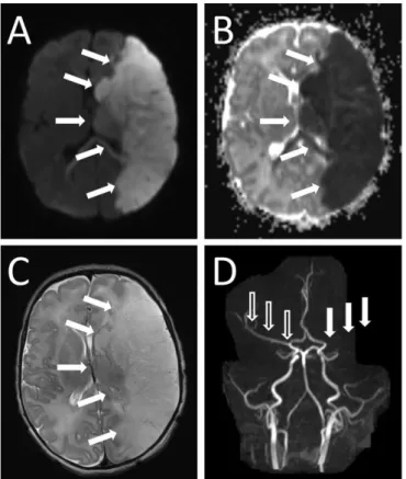 Figure  7.  MRI  and  MRA  images  of  the  brain  of  a  term  neonate  with  NAIS.  