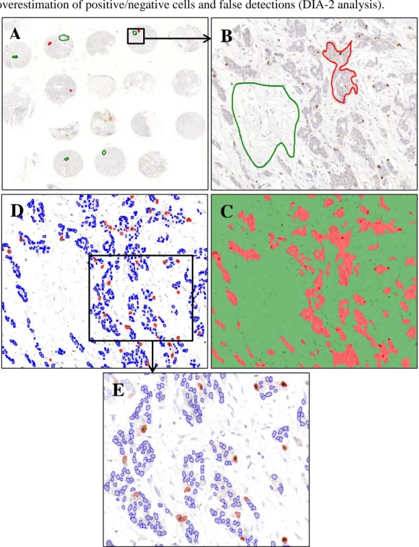 Figure 2: Workflow of 3DHistech DIA assessment. Examples of desired tissue patterns  were given, demarcated with the red and green lines (red = epithel pattern, green =  stroma pattern) [A,B], that we wanted to be recognized and distinguished by the  softw