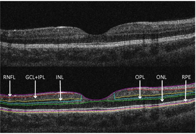 Fig 1. Macular OCT image segmentation using OCTRIMA (A) The image of a healthy macula scanned by the Stratus OCT “ Macular Thickness Map ” protocol