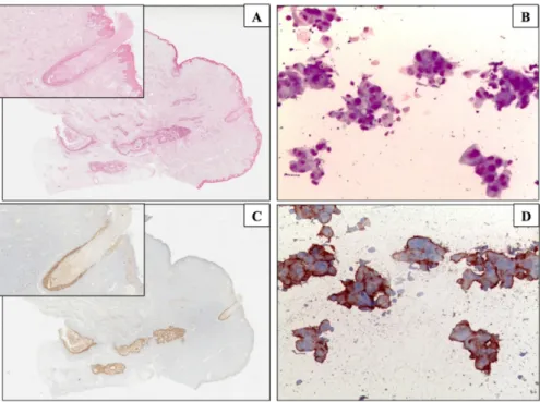 Fig 2. Giemsa staining &amp; ICC. Giemsa staining on ND smear (A) and on the corresponding DCIS (B)