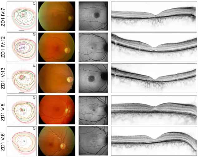 Figure 12: From left to right: Kinetic perimetry results, fundus photography, fundus autofluorescence, and optical coherence  tomography images of the patients of the family with GUCA1A mutations