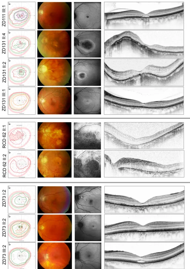 Figure 13: From left to right: Kinetic perimetry results, fundus photography, fundus autofluorescence, and optical coherence  tomography images of the patients of the family with GUCY2D mutations