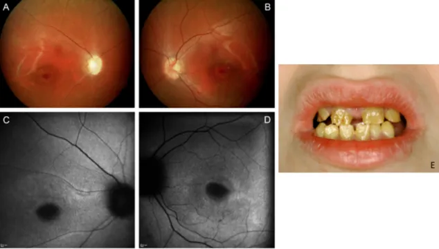 Figure 19: Clinical findings of Jalili syndrome. Fundus (A, B) and autofluorescence images (C, D) showing bilateral optic atrophy  (R&gt;L), additional macular retinal pigment epithelial mottling and atrophy similar to bull’s eye maculopathy