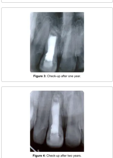 Figure 2: The MTA apical plug and gutta-percha filling of tooth 1.1.