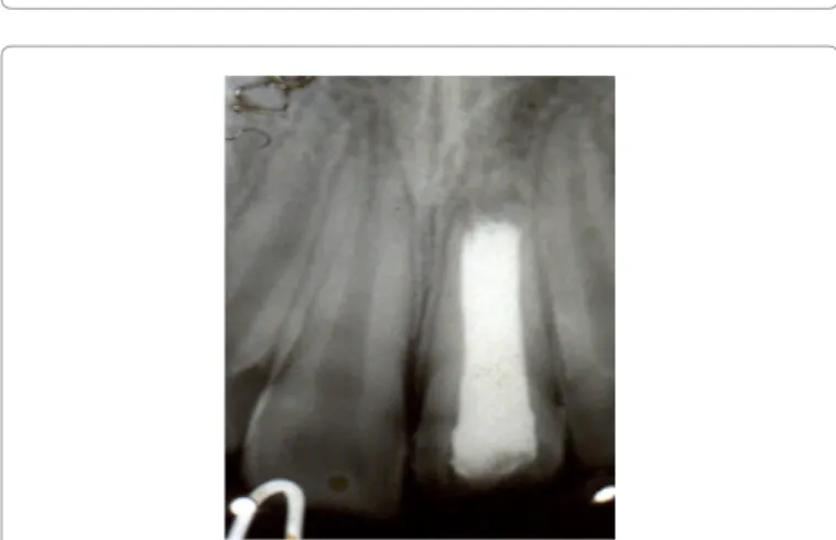 Figure 7: Permanent gutta-percha root canal obturation; 1 year radiographic  check-up.