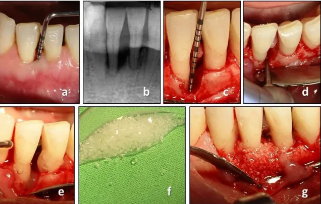 Fig. 1  Reconstructive  periodontal  surgery  with  the  use  of    EMD  +  BCP.  (a)  preoperative  clinical measurement demonstrates a PPD of 9 mm; (b) preoperative radiograph demonstrates  the presence of a deep intrabony defect; (c) intraoperative meas