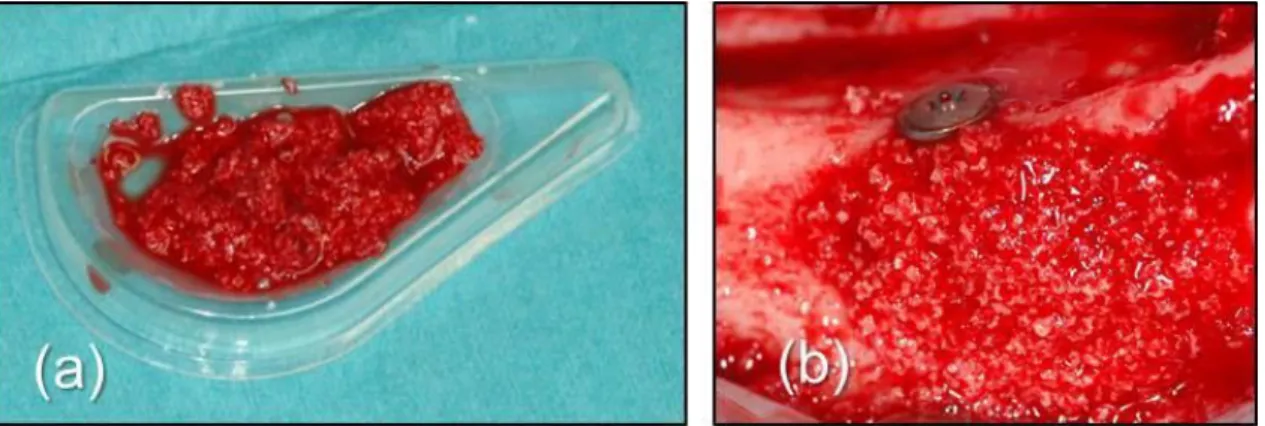 Fig. 13   Three  months  after  baseline:  Group  T1:  (a)  BCP  was  mixed  with  autologous  blood  from  the  surgical site;  (b)  The  exposed  implant surface  in  the  dehiscence  defects  was  covered  with the BCP