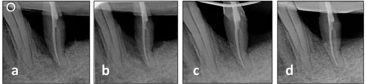 Fig. 6  Increasing  density  of  the  former  defect  is  observable  on  the  radiographs  (a)  prior  to  surgery;  (b)  right  after  surgery;  (c)  after  three  months  of  healing;  (d)  after  seven  months  of  healing