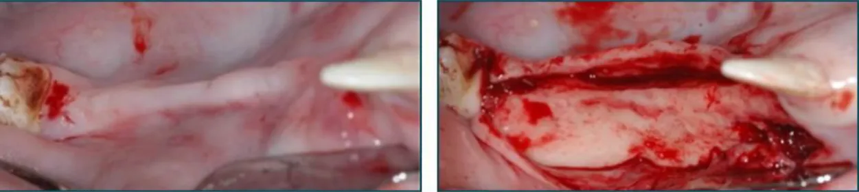 Fig. 18     Removal of the buccal plate after extraction resulted in knife–edge ridge