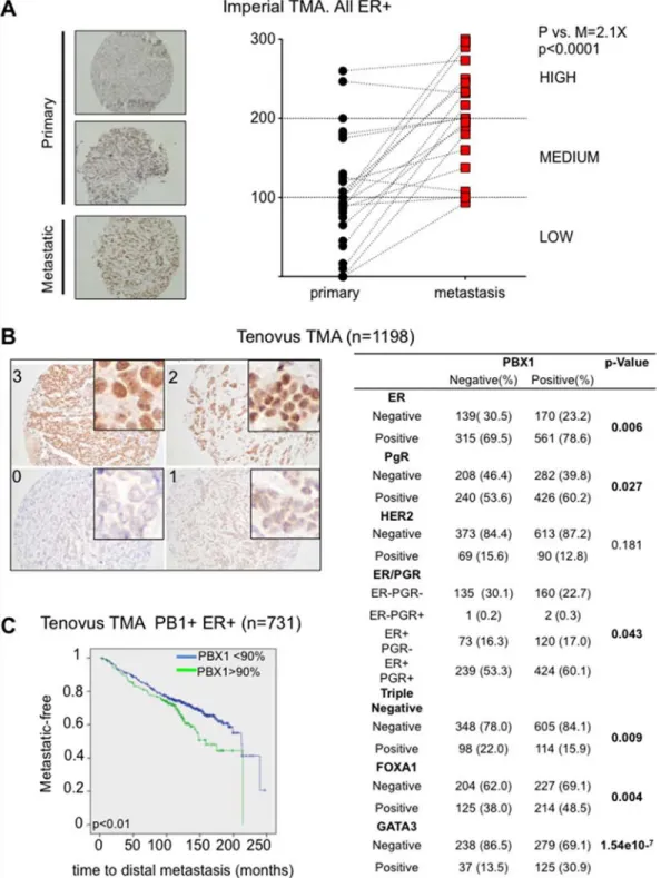 Figure 4: PBX1 is a novel prognostic biomarker for ERα breast cancer.  A. Primary and matched Metastatic samples from the  Imperial College TMA were processed using PBX1 IHC and H score were plotted