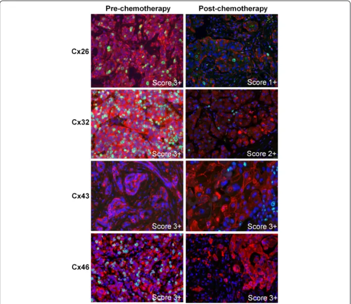Figure 2 Immunofluorescence detection of Cx26, Cx32, Cx43, Cx46 (Alexa 546, red) and Ki67 (Alexa 488, green) in invasive ductal breast cancers prior to (pre-) and after (post-) neoadjuvant chemotherapy