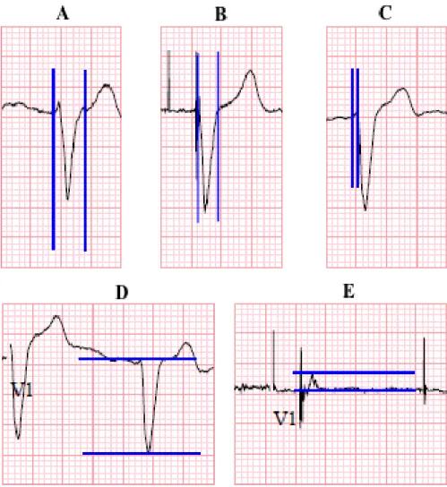 Figure  1.  Measuring  of  the  parameters  of  the  score:  (A)  QRS  duration  before  and  (B)  QRS duration after biventricular pacing, (C) time to ID in V1 lead, (D) Q+S amplitude  before and (E) after CRT