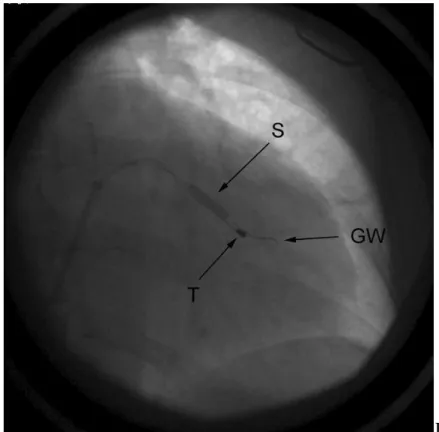 Figure 5. A. Coronary venogram. Arrow 1: stable, distal wedge position, where PNS  was observed