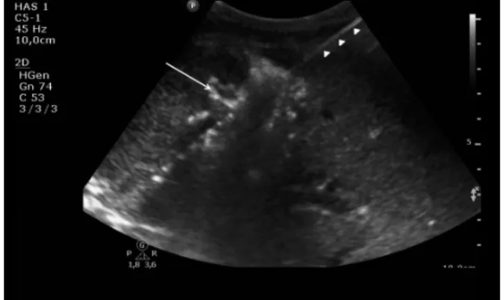 5. ábra A máj jobb lebenyében lévő óriáshaemangioma ultrahangvezé- ultrahangvezé-relt, percutan MWT-kezelése
