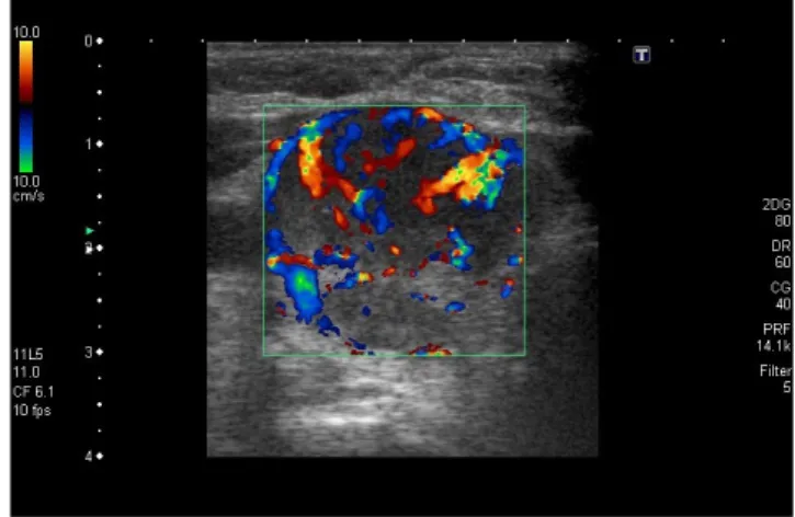 10. ábra A pajzsmirigy jobb lebenyében Doppler-ultrahangvizsgálattal  egy hypervascularizált göb látható