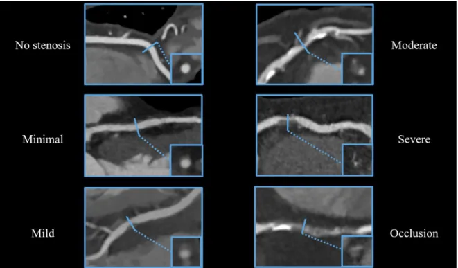 Figure  2.  Representative  images  for  stenosis  classification  using  CTA  images  (own  material)