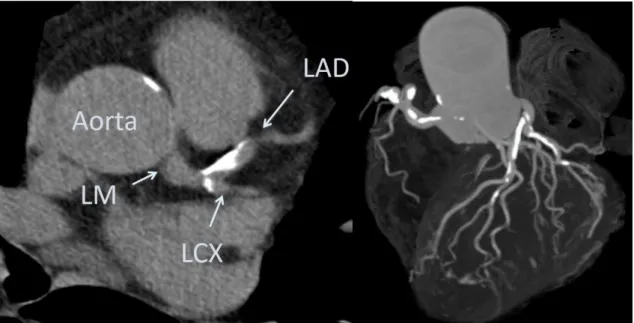 Figure 5. CAC scoring using non-contrast CT images (own material). 