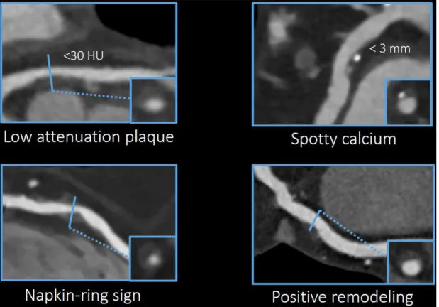 Figure 6. High-risk plaque features in coronary imaging (own material).  