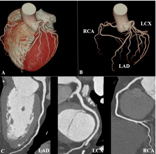 Figure 1. Curved multiplanar and 3D volume-rendered images of the coronary arteries  and the heart (own material) 