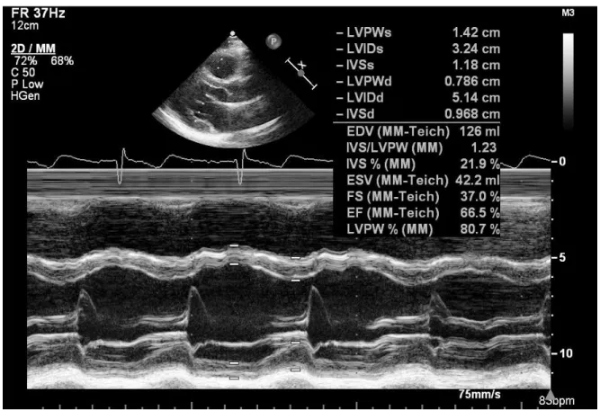 Figure  4.  One-dimensional,  M-mode  linear  measurements  of  the  LV  internal  dimension  in  diastole  and  systole  using Teichholz  method 