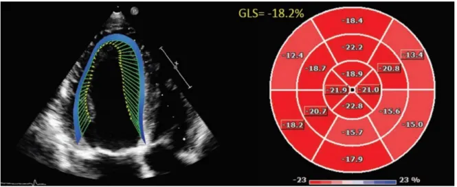 Figure  6.  2D  speckle-tracking  analysis  for  global  longitudinal  strain.  The  graphical  representation (bull’s eye) of peak strain values in a 16-segment model of the LV