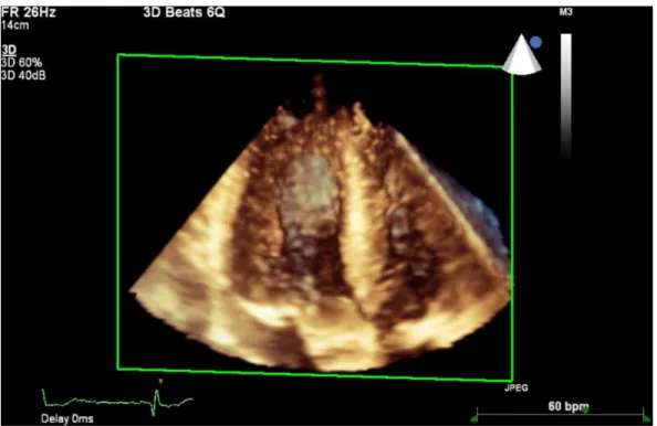 Figure  7.  3D  full-volume  acquisition,  reconstructed  from  6  cardiac  cycles  of  LV  and  RV, obtained from the A4C view