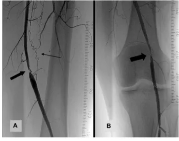 1. ábra A) A beteg 45 éves korában végzett angiográfiás vizsgálat a bal  oldali arteria femoralis superficialis distalis harmadában 0,5 cm  hosszú szakaszon 75%-os szűkületet detektált (vastag nyíl)