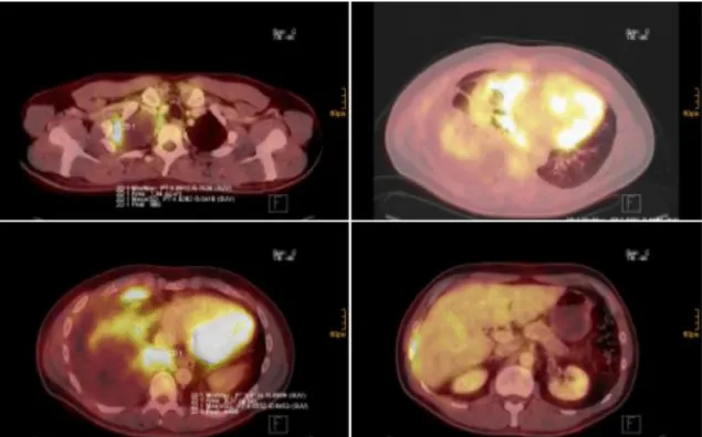 Figure  9:  FDG  PET-CT  images:  MPM  of  the  right  pleural  cavity.  Various  slides  of  CT/PET  fusion  imaging  showing  pleural  tumor  apical  right  (top  left),  involving  the  visceral  and  parietal  pleura  of  the  costodiaphragmatic area (