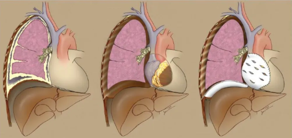 Figure 13: Surgical technique of extended pleurectomy/decortication for MPM. Adopted from [138] 