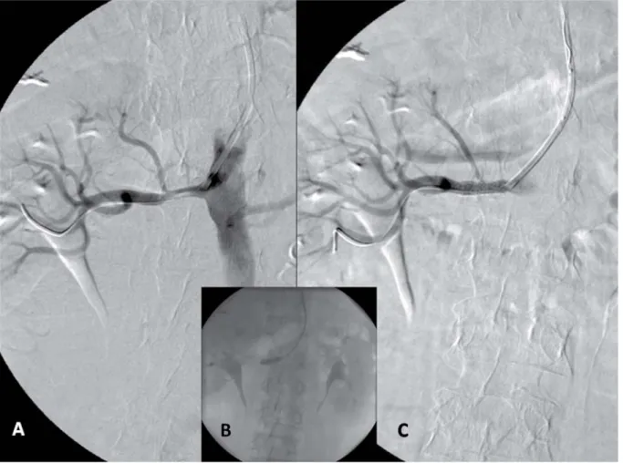 Fig. 1. A: High grade stenosis of the left renal artery and selective cannulation with a Multipurpose 6F guiding catheter