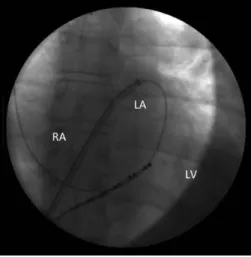 Figure 1. A guide wire in the Left Atrium   after successful transseptal puncture. 