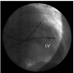 Figure 3B. The EP catheter and the sheath are advanced   into the left ventricle. 