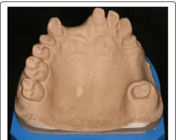 Fig. 2 PMMA reference cast. After digitization with the reference scanner, 10 VPS impressions were taken
