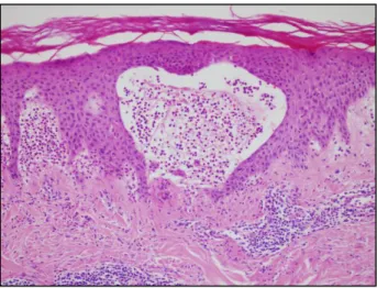 7. ábra. A DH-s bőr szövettani képe (HE, 20x). Szubepidermális hólyagképződés,  perivascularis lymphohistiocyter beszűrődés, a dermális papilla területén neutrophil és 