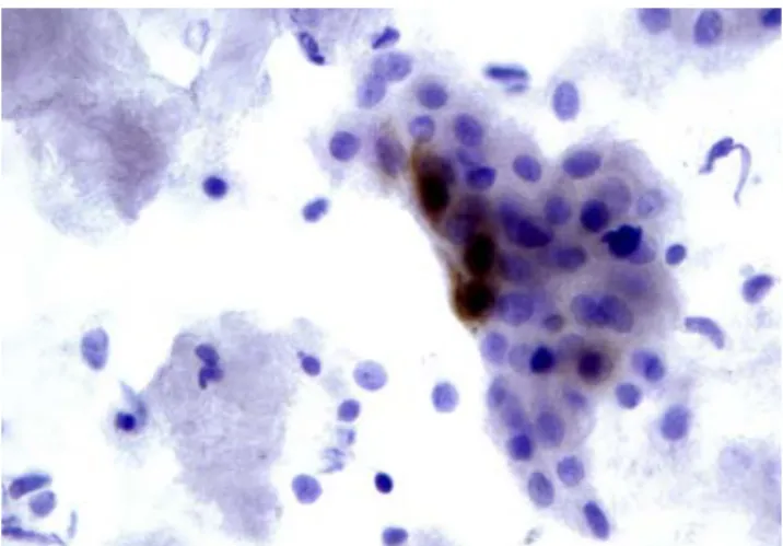 2. ábra. P16 immuncitokémiai reakció méhnyaki kenetben. A pozitív sejtek barnán  festődnek