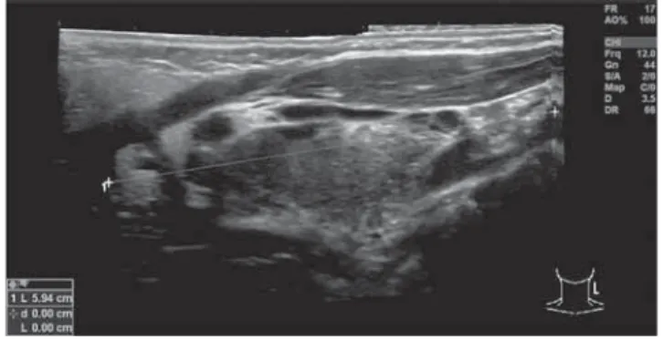 1. ábra UH-vizsgálat, panorámafelvétel: 6 cm átmérőjű lymphangioma  a nyaki régióban – szolid és cystás területekkel