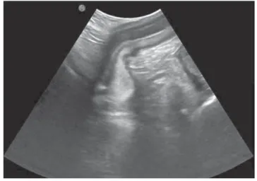 3. ábra Szonocisztográﬁ a, mictio: a kontrasztanyag az ép urethrában  látható
