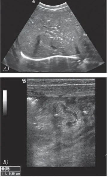 4. ábra A)   UH-vizsgálat, harántmetszet: a májban számtalan apró  echódús képlet – portalis levegő