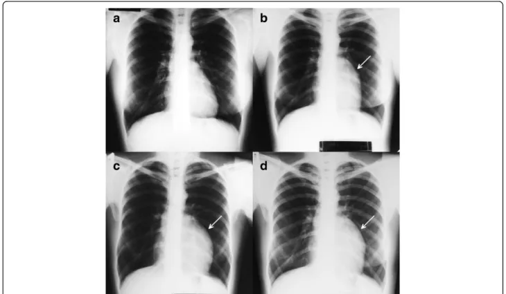 Fig. 1 Chest X-ray examinations performed in 2004 (panel a), 2007 (panel b), 2010 (panel c) and in 2014 (panel d)