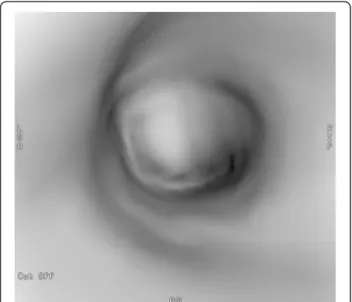 Figure 4 Intrabronchial plasmacytoma consisted of atypical plasma cells (HE magnification 100×).