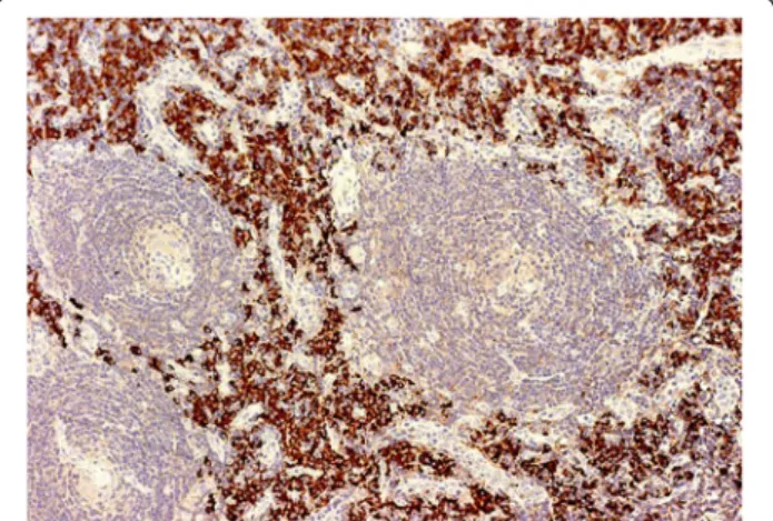 Figure 7 Mixed variant of Castleman disease with lambda monoclonal plasma cell infiltration (magnification 400×).