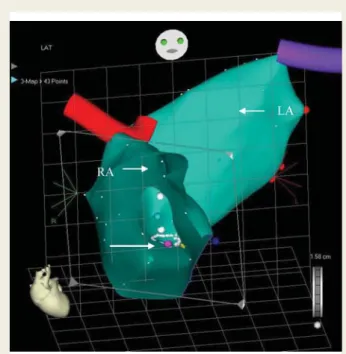 Figure 2 Patient 1. CARTO image, left lateral projection. Right and the LV activation map: the earliest activation site is the right ventricular anteroseptal region; the latest site is the mid-basal part of the posterolateral wall.