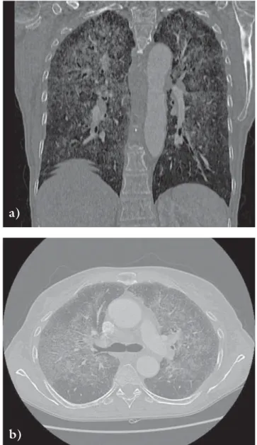 4. ábra Sarcoidosisra jellegzetes epitheloid sejtes granulomák tüdőbiop- tüdőbiop-sziás mintában (hematoxilin-eozin festés, közepes nagyítás)1