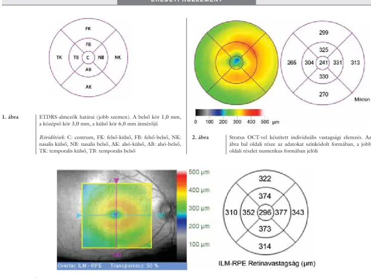 1. ábra ETDRS-almezők határai (jobb szemen). A belső kör 1,0 mm,  a középső kör 3,0 mm, a külső kör 6,0 mm átmérőjű