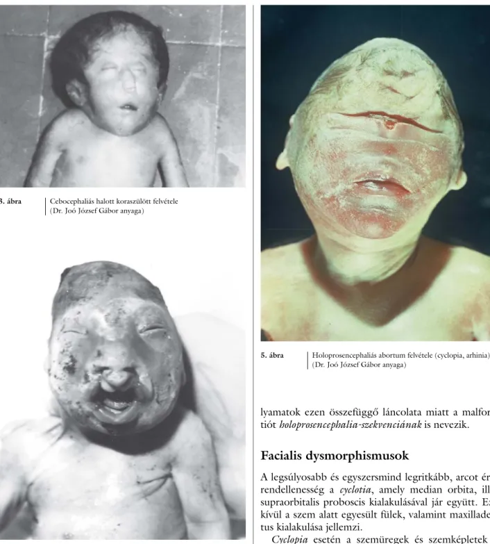 4. ábra Holoprosencephalia miatt végzett terhességmegszakításból  származó abortum felvétele (facialis dysmorphismus)