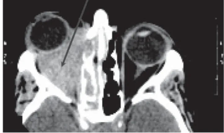 5. ábra Retrobulbaris granuloma kialakulása