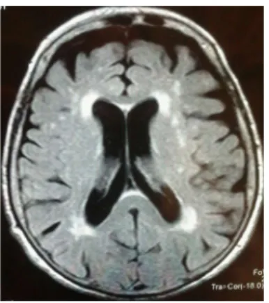 Figure 1  White matter hyperintensities as assessed by magnetic reso- reso-nance images