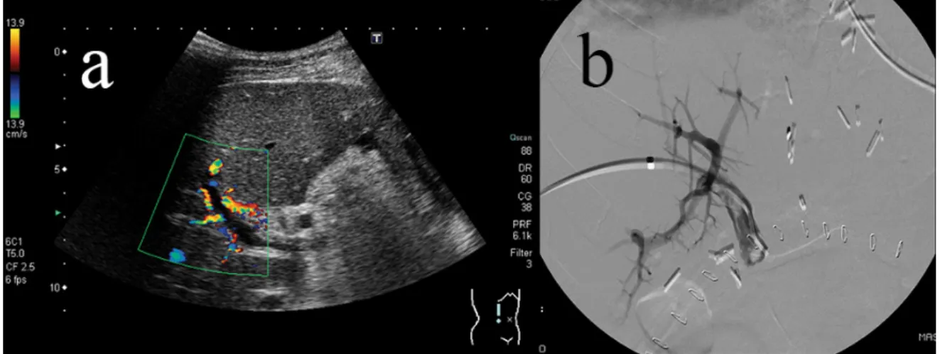 4. ábra Részleges vena portae thrombosis képe color-Doppler-UH-képen (a) és DSA-felvételen (b), 24 órával a májtranszplantáció után DSA = digitális szubtrakciós angiográfia