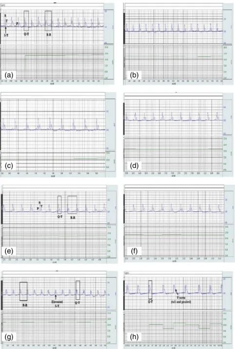 Fig. 2. Normal ECG waves and intervals in the NC group (a), the Ali group (b), the ISO group (c), and the Ali + ISO group (d) at Day 0 and in the NC group (e) at Day 5, tall peaked T-wave in the Ali group (f), elevated ST segment in